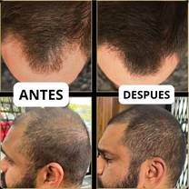 Tiveno® - Pigmento Capilar Masculino