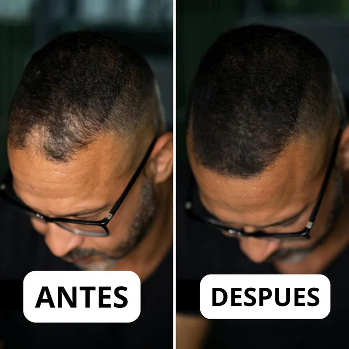 Tiveno® - Pigmento Capilar Masculino